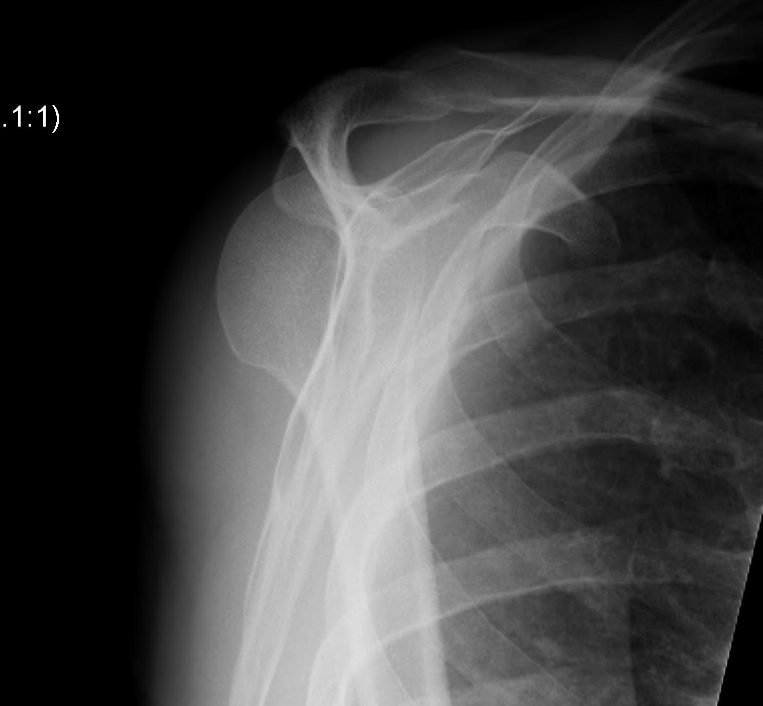 Posterior Shoulder Dislocation Lateral
